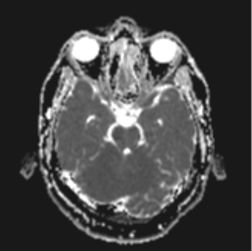 File:Cerebellar hemangioblastomas and pituitary adenoma (Radiopaedia 85490-101176 Axial ADC 12).png