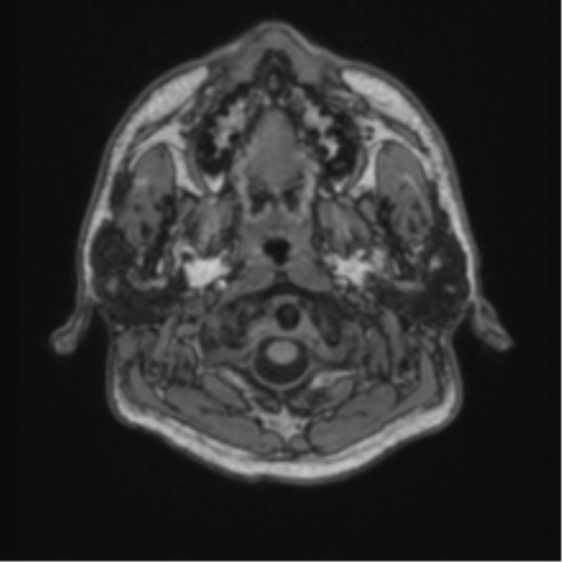 File:Cerebellar hemangioblastomas and pituitary adenoma (Radiopaedia 85490-101176 Axial T1 2).png