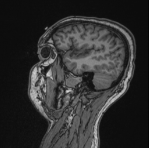 File:Cerebellar hemangioblastomas and pituitary adenoma (Radiopaedia 85490-101176 Sagittal T1 33).png