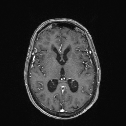 Cerebellar metastases (Radiopaedia 24038-24249 Axial T1 C+ 13).jpg