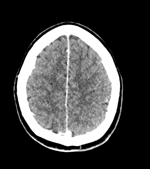 Cerebellar metastases - colorectal adenocarcinoma (Radiopaedia 40947-43652 Axial C+ 51).png
