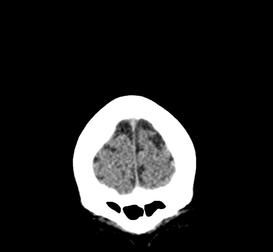 Cerebellar metastases - colorectal adenocarcinoma (Radiopaedia 40947-43652 Coronal non-contrast 13).png