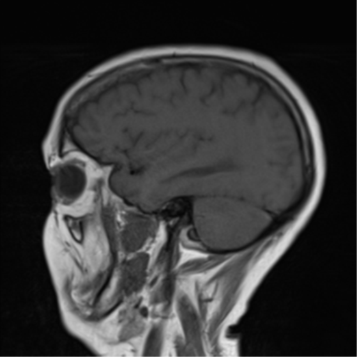 File:Cerebellar metastasis (Radiopaedia 54578-60810 Sagittal T1 5).png