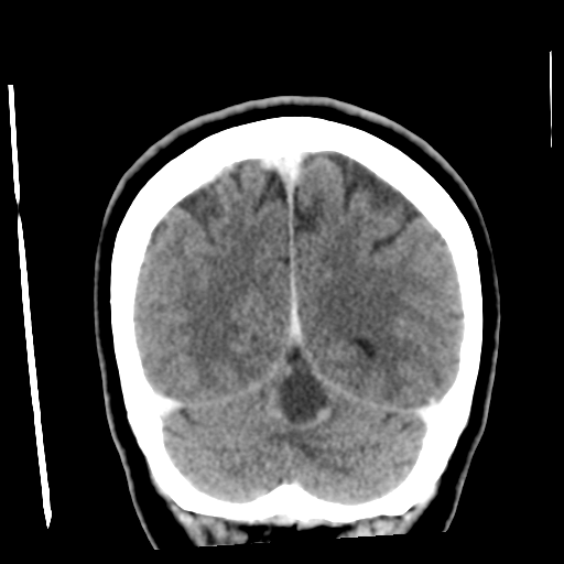 Cerebellar metastasis (cystic appearance) (Radiopaedia 41395-44258 D 48).png