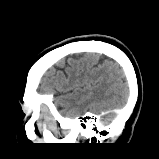 Cerebellar metastasis (cystic appearance) (Radiopaedia 41395-44258 F 42).png