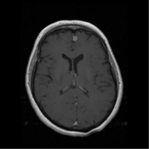 File:Cerebellar metastasis (cystic appearance) (Radiopaedia 41395-44262 Axial T1 C+ 12).png