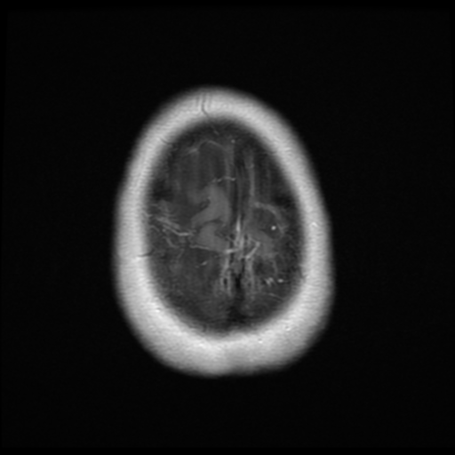 File:Cerebellar metastasis (cystic appearance) (Radiopaedia 41395-44268 Axial T1 C+ 22).png