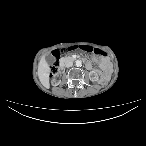 Cerebellar metastasis - lung tumor (Radiopaedia 69317-79150 A 44).jpg