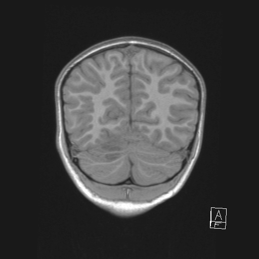 Cerebellar stroke (Radiopaedia 32202-33150 Coronal T1 48).png