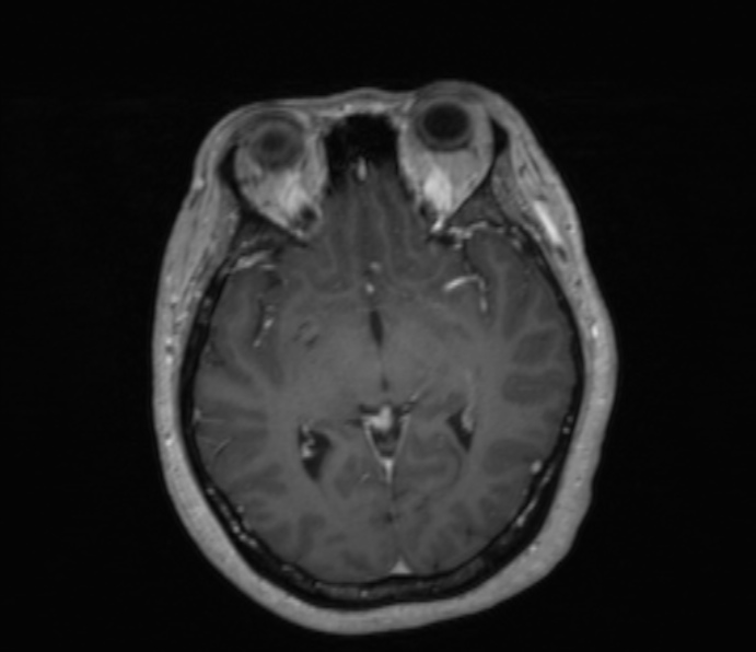 Cerebellopontine angle meningioma (Radiopaedia 35181-36715 Axial T1 C+ 31).jpg