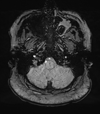 File:Cerebellopontine angle meningioma (Radiopaedia 48434-53348 Axial SWI 13).png