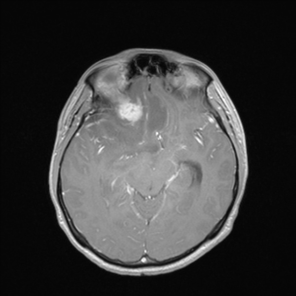 Cerebral abscess (Radiopaedia 24212-24478 Axial T1 C+ 28).jpg