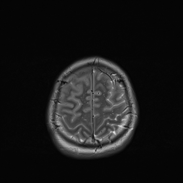 Cerebral abscess (Radiopaedia 24212-24478 Axial T2 51).jpg