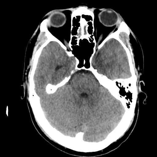 File:Cerebral abscess (Radiopaedia 29451-29919 Axial non-contrast 16).jpg