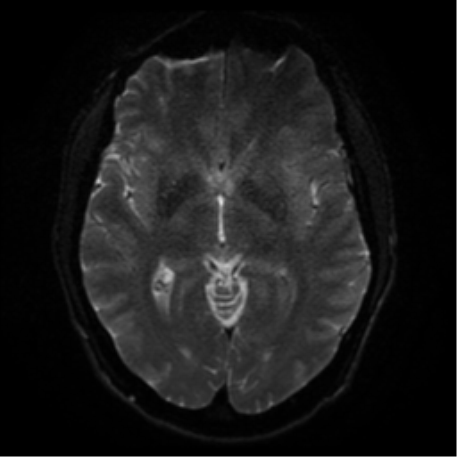 Cerebral abscess (Radiopaedia 57774-64740 Axial DWI 42).png