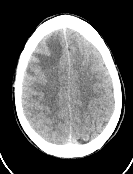 Cerebral abscess (Radiopaedia 60342-68008 Axial non-contrast 39).png