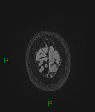 Cerebral abscess and subdural empyema (Radiopaedia 84436-99779 Axial FLAIR 13).jpg