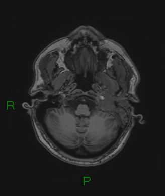 Cerebral abscess and subdural empyema (Radiopaedia 84436-99779 Axial T1 70).jpg