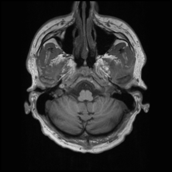 File:Cerebral abscess with ventriculitis (Radiopaedia 78965-91878 Axial T1 8).jpg