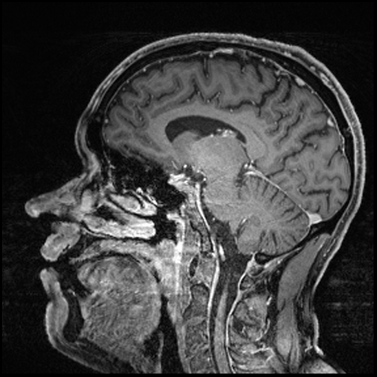 Cerebral abscess with ventriculitis (Radiopaedia 78965-91878 Sagittal T1 C+ 102).jpg