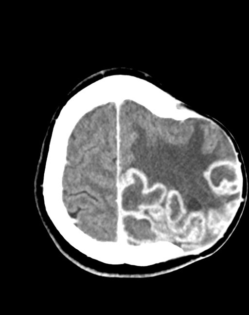 Cerebral abscesses (Radiopaedia 70458-80568 Axial Contrast 50).jpg