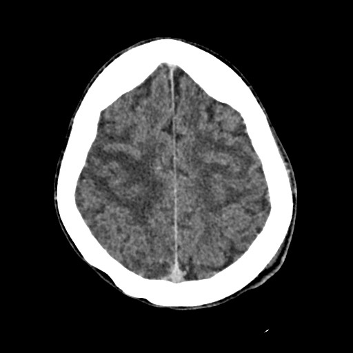 File:Cerebral amyloid angiopathy-related inflammation (Radiopaedia 74836-85848 Axial non-contrast 47).jpg