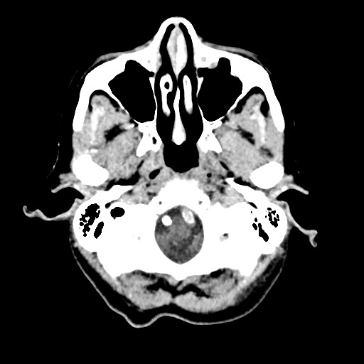 File:Cerebral amyloid angiopathy-related inflammation (Radiopaedia 74836-85848 Axial non-contrast 9).jpg