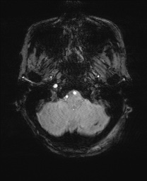 File:Cerebral amyloid angiopathy-related inflammation (Radiopaedia 74836-85849 Axial SWI 10).jpg