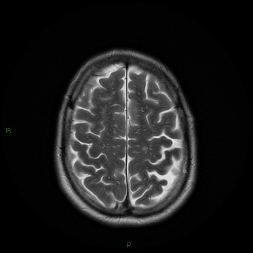 File:Cerebral amyloid angiopathy (Radiopaedia 77506-89664 Axial T2 23).jpg