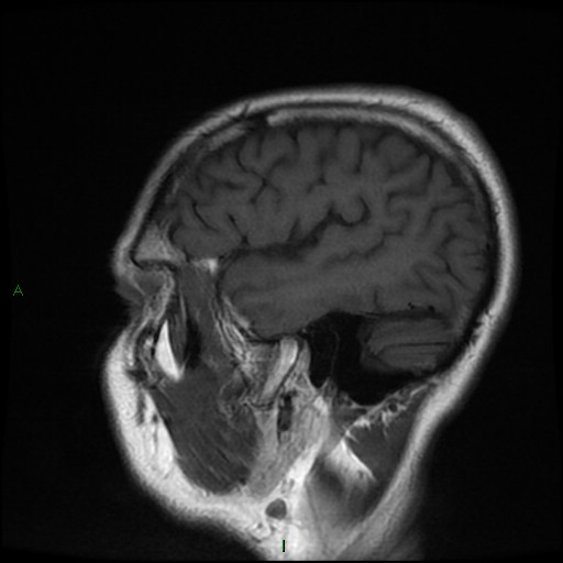 File:Cerebral amyloid angiopathy (Radiopaedia 77506-89664 Coronal T1 6).jpg