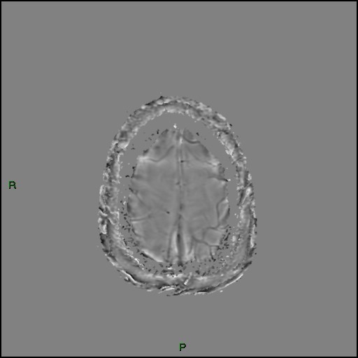 Cerebral amyloid angiopathy (Radiopaedia 77506-89664 H 93).jpg