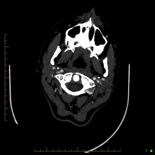 Cerebral arteriovenous malformation (AVM) (Radiopaedia 78162-90706 Axial CTA 29).jpg