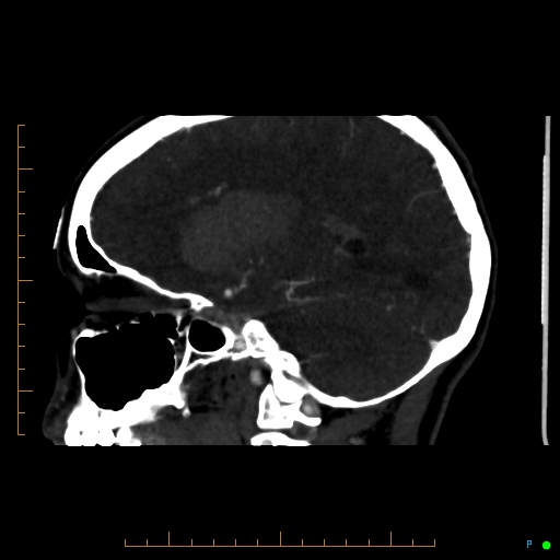 Cerebral arteriovenous malformation (AVM) (Radiopaedia 78162-90706 Sagittal CTA 33).jpg