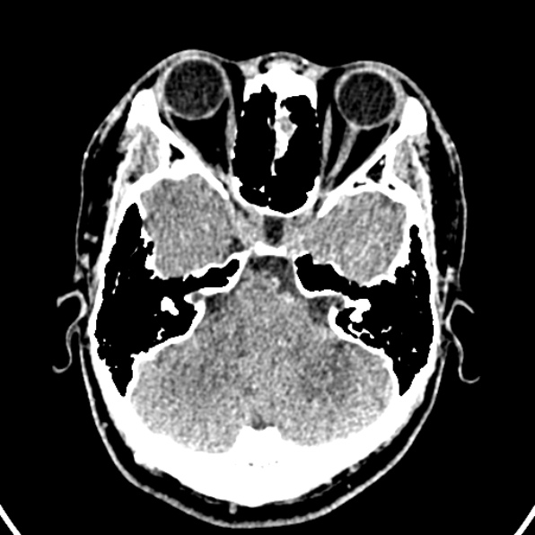 Cerebral arteriovenous malformation (Radiopaedia 37182-39012 Axial non-contrast 11).jpg