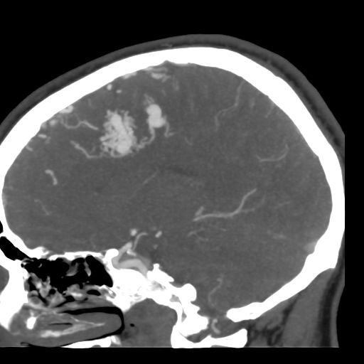 Cerebral arteriovenous malformation (Radiopaedia 39259-41505 Sagittal 27).png
