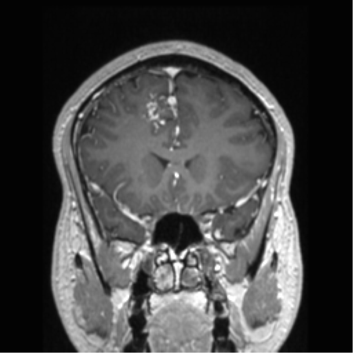 Cerebral arteriovenous malformation (Radiopaedia 39259-41506 Coronal T1 C+ 65).png