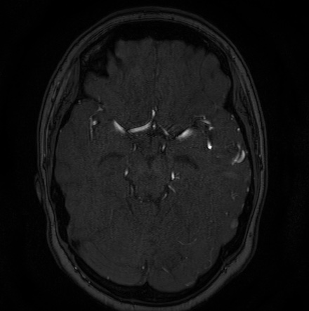 Cerebral arteriovenous malformation (Radiopaedia 74411-85654 Axial MRA 50).jpg