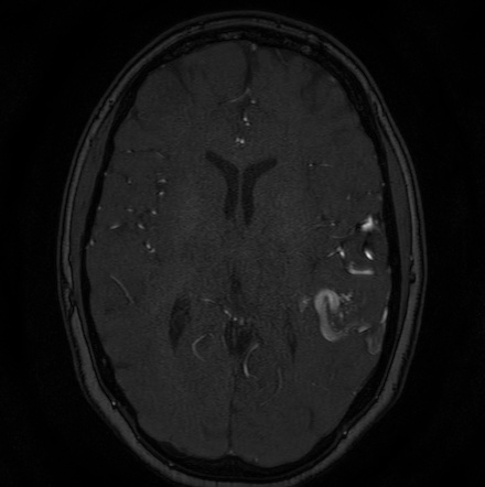 Cerebral arteriovenous malformation (Radiopaedia 74411-85654 Axial MRA 80).jpg