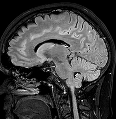 File:Cerebral arteriovenous malformation (Radiopaedia 74411-85746 Sagittal FLAIR 49).jpg