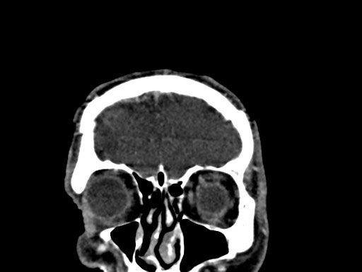 Cerebral arteriovenous malformation (Radiopaedia 78188-90746 Coronal C+ delayed 8).jpg