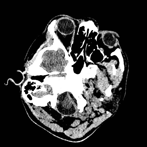 Cerebral arteriovenous malformation (Radiopaedia 79677-92887 Axial non-contrast 3).jpg