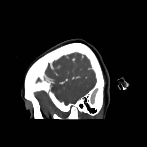 File:Cerebral arteriovenous malformation (Radiopaedia 79677-92888 C 3).jpg