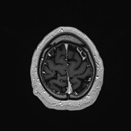 Cerebral arteriovenous malformation (Radiopaedia 84015-99245 Axial T1 C+ 137).jpg