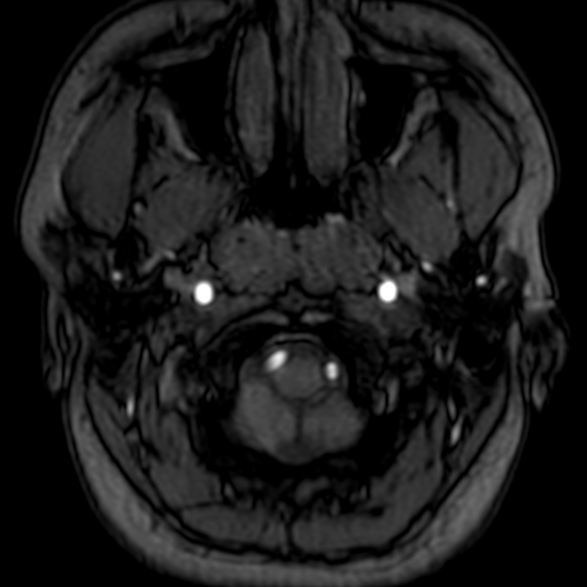 Cerebral arteriovenous malformation at posterior body of corpus callosum (Radiopaedia 74111-84925 Axial MRA 1).jpg