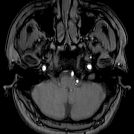 Cerebral arteriovenous malformation at posterior body of corpus callosum (Radiopaedia 74111-84925 Axial MRA 24).jpg