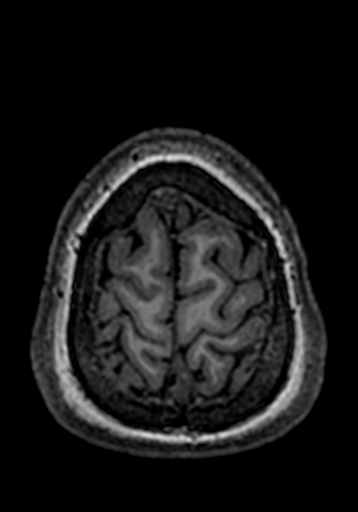 Cerebral arteriovenous malformation at posterior body of corpus callosum (Radiopaedia 74111-84925 Axial T1 15).jpg