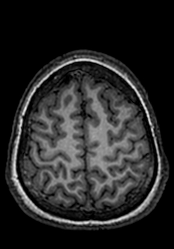 Cerebral arteriovenous malformation at posterior body of corpus callosum (Radiopaedia 74111-84925 Axial T1 42).jpg