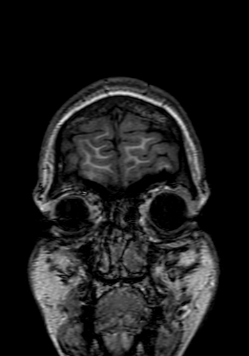 File:Cerebral arteriovenous malformation at posterior body of corpus callosum (Radiopaedia 74111-84925 Coronal T1 1).jpg