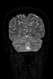 Cerebral arteriovenous malformation at posterior body of corpus callosum (Radiopaedia 74111-84925 Coronal T2 150).jpg