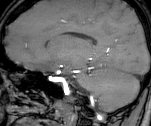 File:Cerebral arteriovenous malformation at posterior body of corpus callosum (Radiopaedia 74111-84925 J 236).jpg